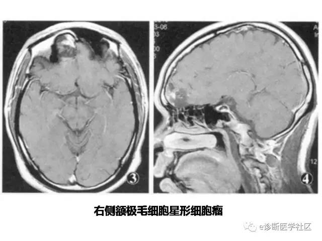 【病例】毛细胞型星形细胞瘤1例MR影像表现