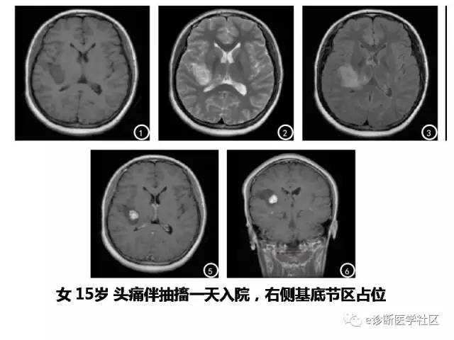 【病例】毛细胞型星形细胞瘤1例MR影像表现