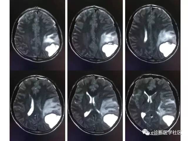 【病例】脑实质内室管膜瘤1例MR影像表现与鉴别