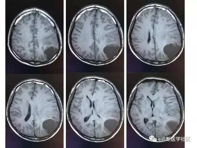 【病例】脑实质内室管膜瘤1例MR影像表现与鉴别