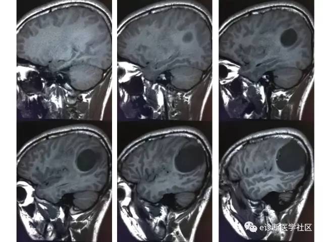 【病例】脑实质内室管膜瘤1例MR影像表现与鉴别