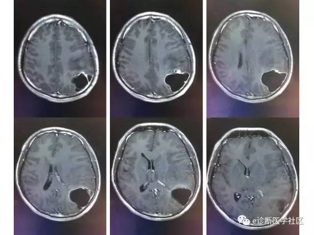 【病例】脑实质内室管膜瘤1例MR影像表现与鉴别