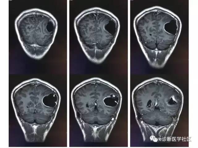 【病例】脑实质内室管膜瘤1例MR影像表现与鉴别