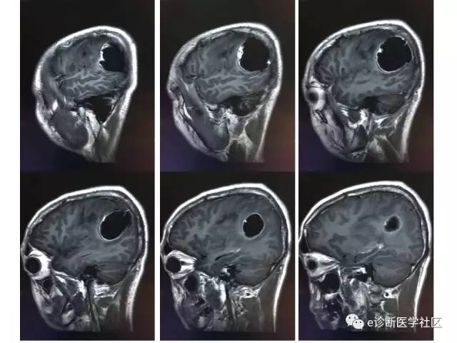 【病例】脑实质内室管膜瘤1例MR影像表现与鉴别