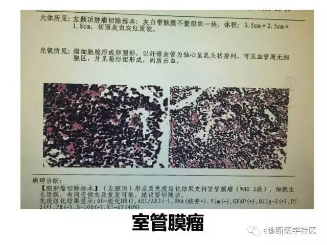 【病例】脑实质内室管膜瘤1例MR影像表现与鉴别