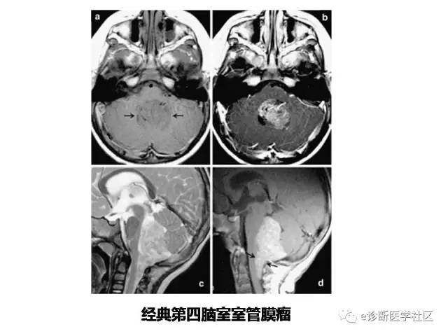 【病例】脑实质内室管膜瘤1例MR影像表现与鉴别