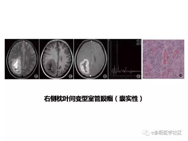 【病例】脑实质内室管膜瘤1例MR影像表现与鉴别