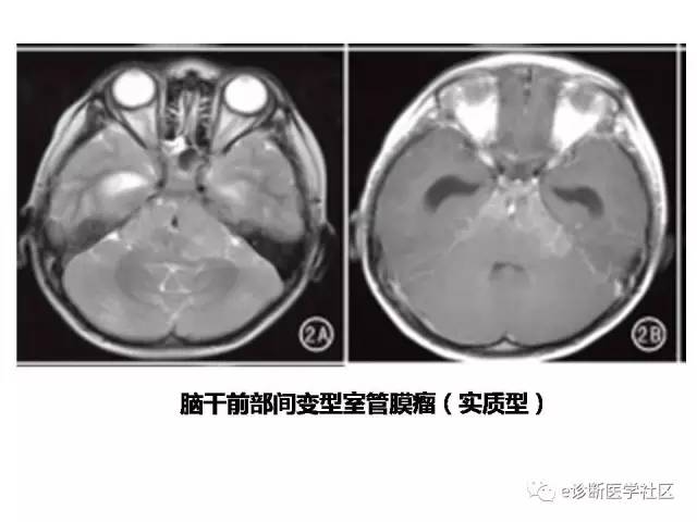 【病例】脑实质内室管膜瘤1例MR影像表现与鉴别