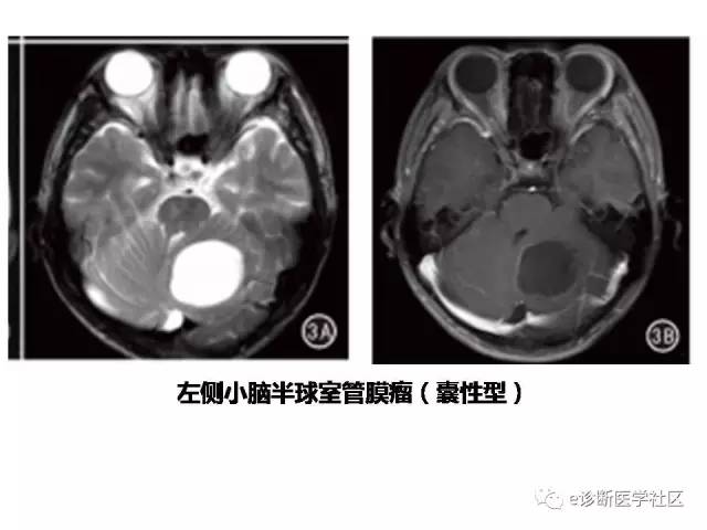【病例】脑实质内室管膜瘤1例MR影像表现与鉴别