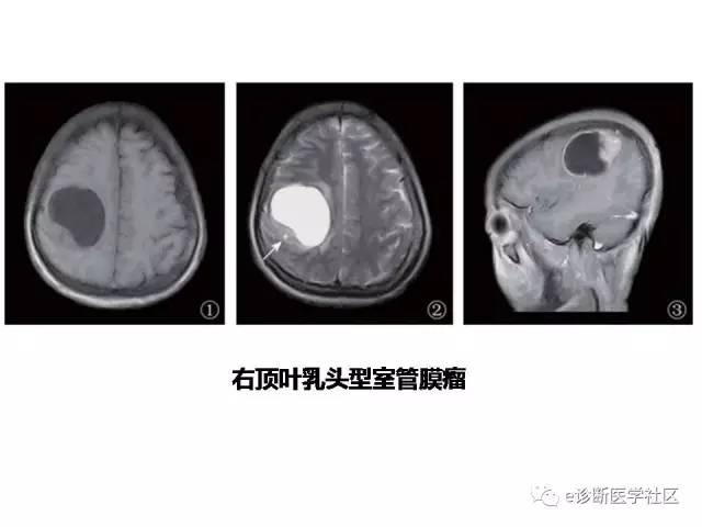 【病例】脑实质内室管膜瘤1例MR影像表现与鉴别