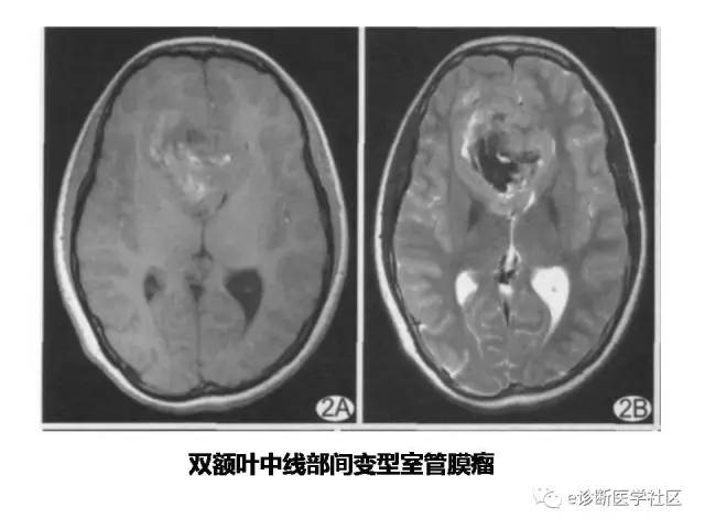 【病例】脑实质内室管膜瘤1例MR影像表现与鉴别