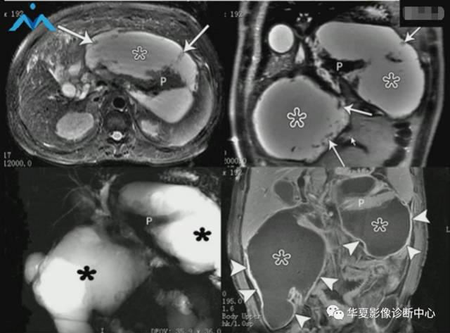 急性坏死性胰腺炎的局部并发症——