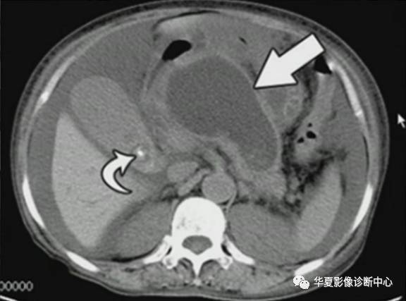 急性坏死性胰腺炎的局部并发症——