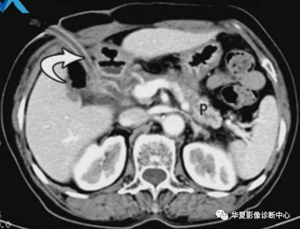 急性坏死性胰腺炎的局部并发症——