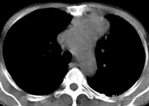 【病例】胸腺癌1例CT影像表现 【病例】胸腺癌1例CT影像表现