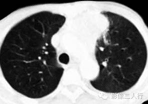 【病例】胸腺癌1例CT影像表现 【病例】胸腺癌1例CT影像表现