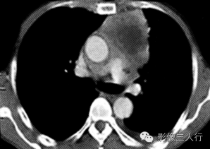 【病例】胸腺癌1例CT影像表现 【病例】胸腺癌1例CT影像表现
