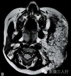 【病例】颌面部巨大周围型神经纤维瘤1例MR影像表现