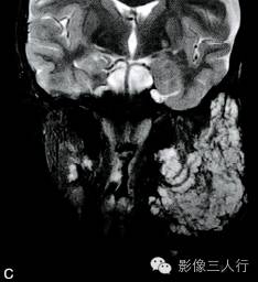 【病例】颌面部巨大周围型神经纤维瘤1例MR影像表现 【病例】颌面部巨大周围型神经纤维瘤1例MR影像表现