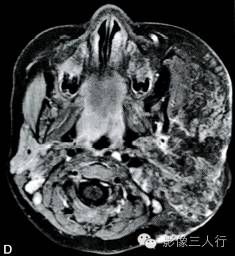 【病例】颌面部巨大周围型神经纤维瘤1例MR影像表现 【病例】颌面部巨大周围型神经纤维瘤1例MR影像表现