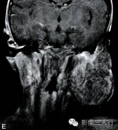 【病例】颌面部巨大周围型神经纤维瘤1例MR影像表现 【病例】颌面部巨大周围型神经纤维瘤1例MR影像表现