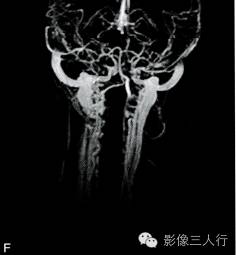 【病例】颌面部巨大周围型神经纤维瘤1例MR影像表现 【病例】颌面部巨大周围型神经纤维瘤1例MR影像表现