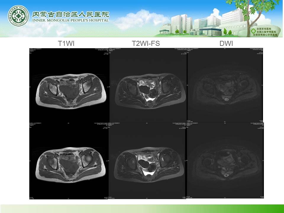 【病例】右侧附件区卵泡膜细胞瘤1例MR