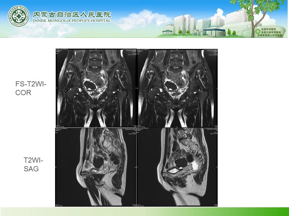 【病例】右侧附件区卵泡膜细胞瘤1例MR