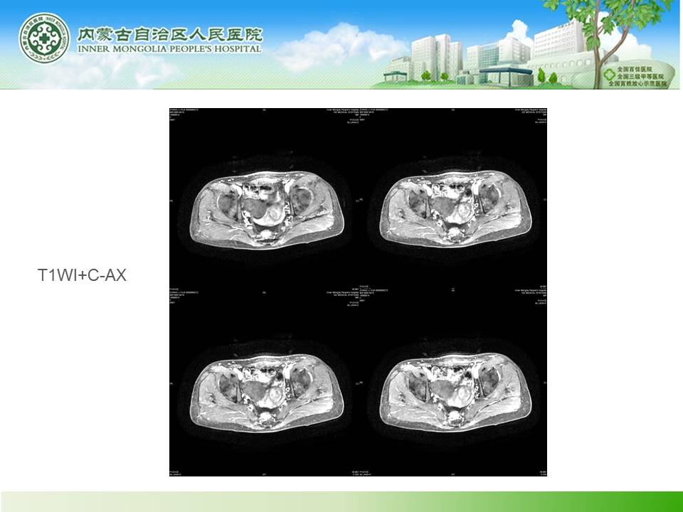 【病例】右侧附件区卵泡膜细胞瘤1例MR