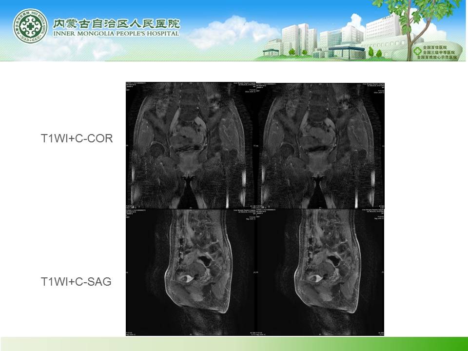 【病例】右侧附件区卵泡膜细胞瘤1例MR