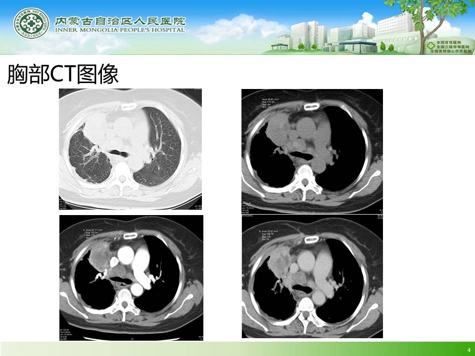【病例】肺炎伴纵隔淋巴结肿大1例CT