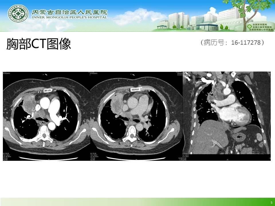 【病例】肺炎伴纵隔淋巴结肿大1例CT