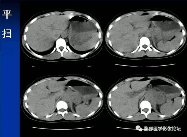 【病例】腹膜后胚胎性横纹肌肉瘤1例CT影像表现 【病例】腹膜后胚胎性横纹肌肉瘤1例CT影像表现