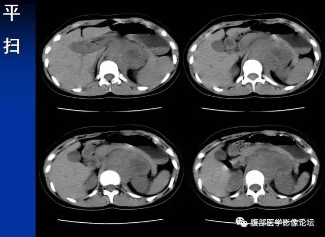 【病例】腹膜后胚胎性横纹肌肉瘤1例CT影像表现 【病例】腹膜后胚胎性横纹肌肉瘤1例CT影像表现