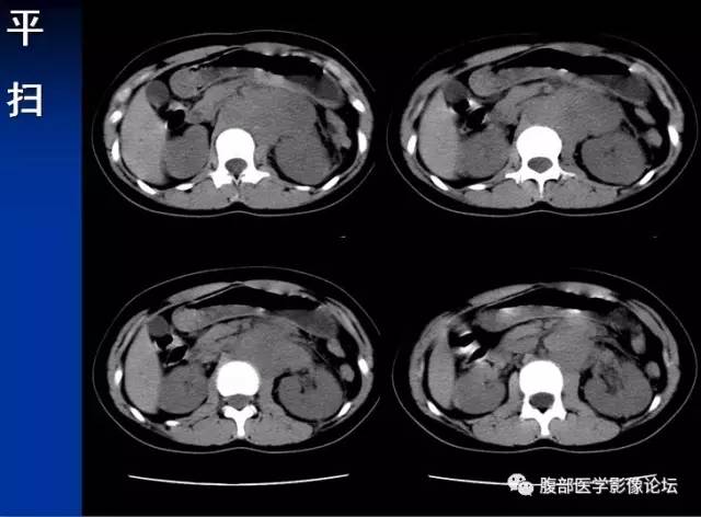【病例】腹膜后胚胎性横纹肌肉瘤1例CT影像表现 【病例】腹膜后胚胎性横纹肌肉瘤1例CT影像表现