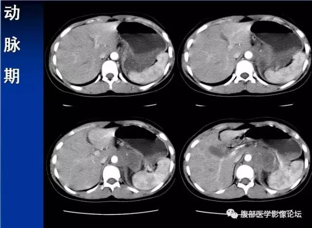 【病例】腹膜后胚胎性横纹肌肉瘤1例CT影像表现 【病例】腹膜后胚胎性横纹肌肉瘤1例CT影像表现