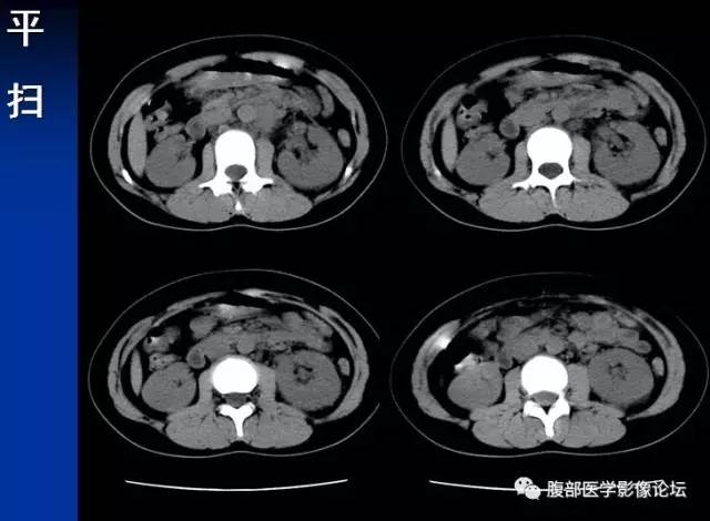 【病例】腹膜后胚胎性横纹肌肉瘤1例CT影像表现 【病例】腹膜后胚胎性横纹肌肉瘤1例CT影像表现