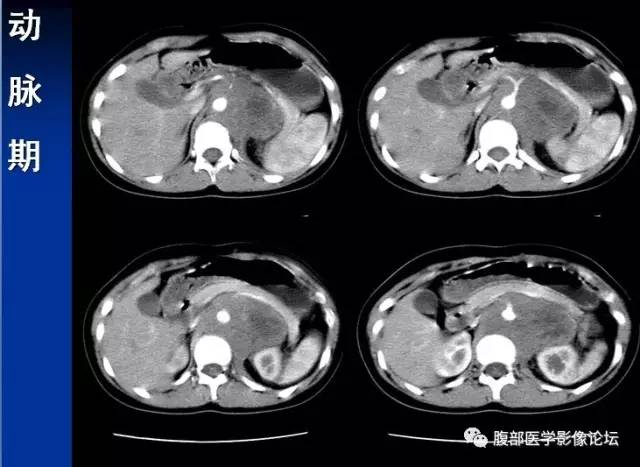 【病例】腹膜后胚胎性横纹肌肉瘤1例CT影像表现 【病例】腹膜后胚胎性横纹肌肉瘤1例CT影像表现