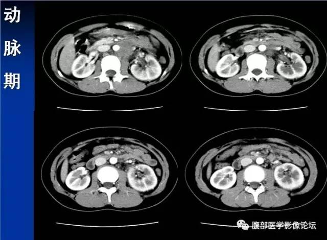 【病例】腹膜后胚胎性横纹肌肉瘤1例CT影像表现 【病例】腹膜后胚胎性横纹肌肉瘤1例CT影像表现