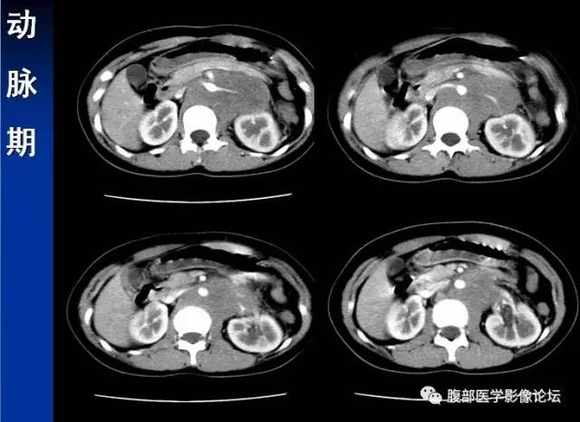 【病例】腹膜后胚胎性横纹肌肉瘤1例CT影像表现 【病例】腹膜后胚胎性横纹肌肉瘤1例CT影像表现