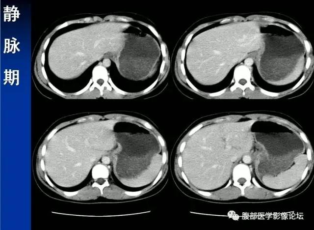 【病例】腹膜后胚胎性横纹肌肉瘤1例CT影像表现 【病例】腹膜后胚胎性横纹肌肉瘤1例CT影像表现