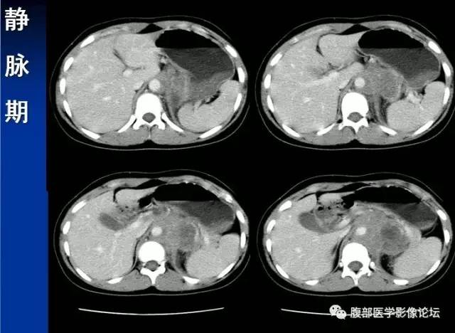 【病例】腹膜后胚胎性横纹肌肉瘤1例CT影像表现 【病例】腹膜后胚胎性横纹肌肉瘤1例CT影像表现