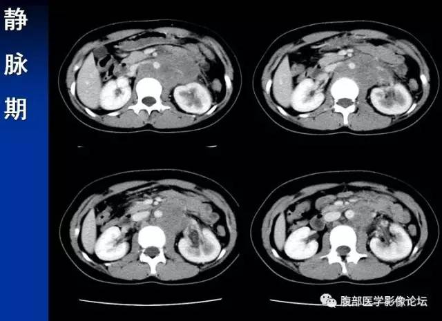 【病例】腹膜后胚胎性横纹肌肉瘤1例CT影像表现 【病例】腹膜后胚胎性横纹肌肉瘤1例CT影像表现
