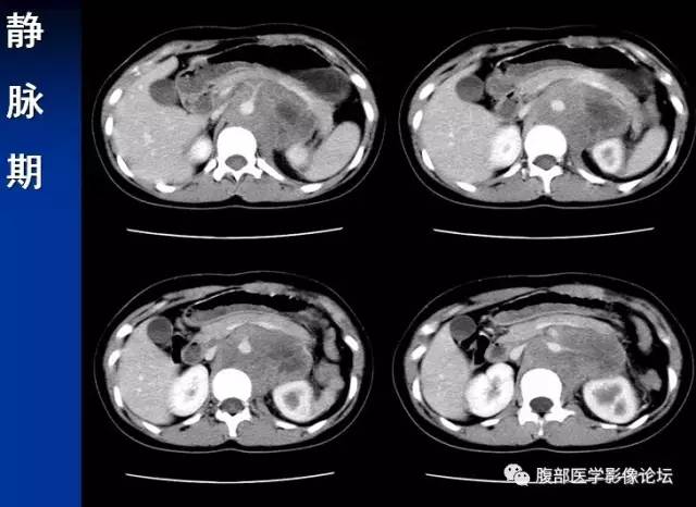 【病例】腹膜后胚胎性横纹肌肉瘤1例CT影像表现 【病例】腹膜后胚胎性横纹肌肉瘤1例CT影像表现
