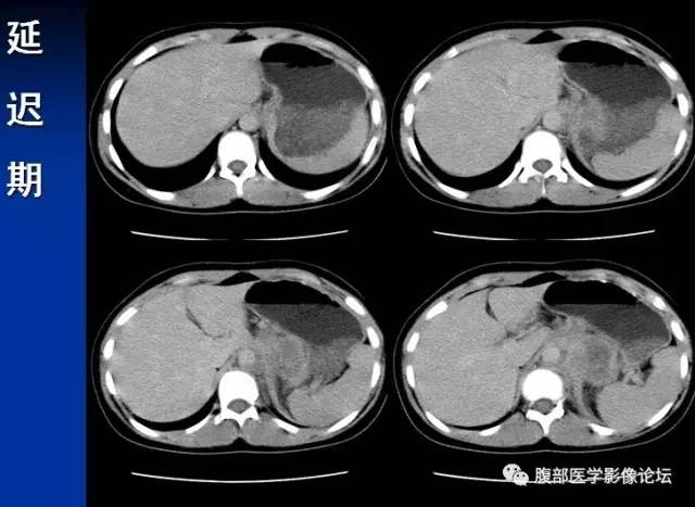 【病例】腹膜后胚胎性横纹肌肉瘤1例CT影像表现 【病例】腹膜后胚胎性横纹肌肉瘤1例CT影像表现