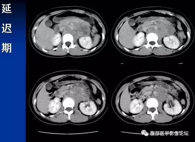 【病例】腹膜后胚胎性横纹肌肉瘤1例CT影像表现 【病例】腹膜后胚胎性横纹肌肉瘤1例CT影像表现