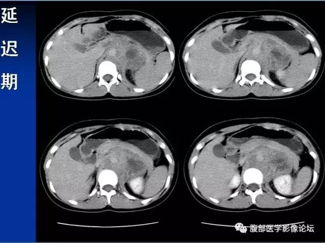 【病例】腹膜后胚胎性横纹肌肉瘤1例CT影像表现 【病例】腹膜后胚胎性横纹肌肉瘤1例CT影像表现