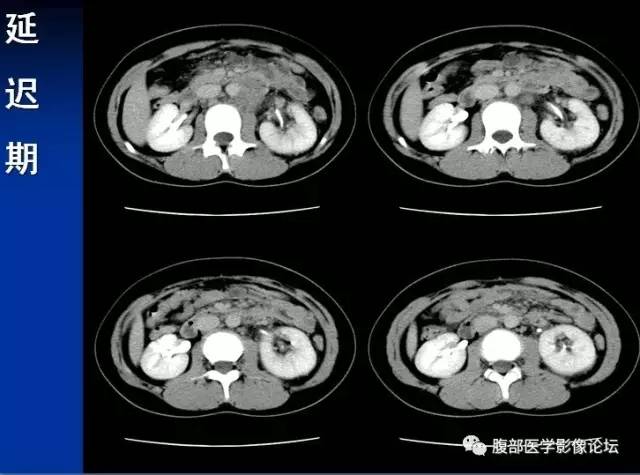 【病例】腹膜后胚胎性横纹肌肉瘤1例CT影像表现 【病例】腹膜后胚胎性横纹肌肉瘤1例CT影像表现
