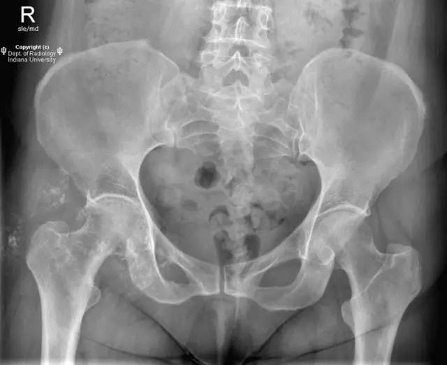 【病例】髋关节滑膜骨软骨瘤病1例X线及MR影像表现
