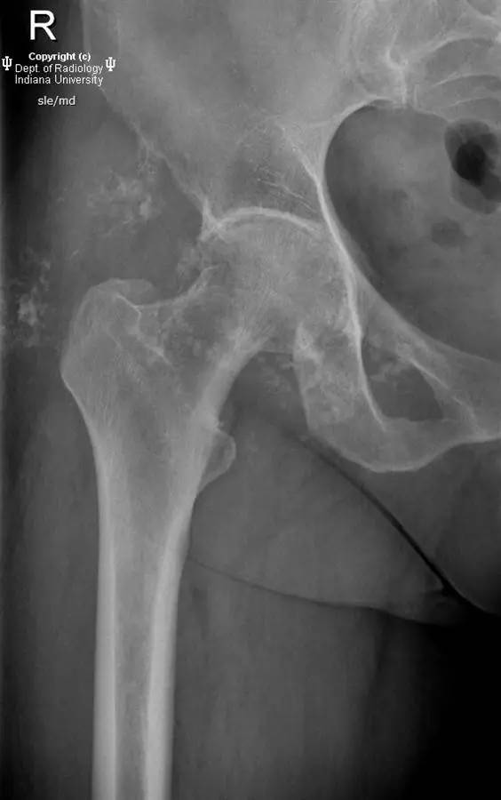 【病例】髋关节滑膜骨软骨瘤病1例X线及MR影像表现 【病例】髋关节滑膜骨软骨瘤病1例X线及MR影像表现